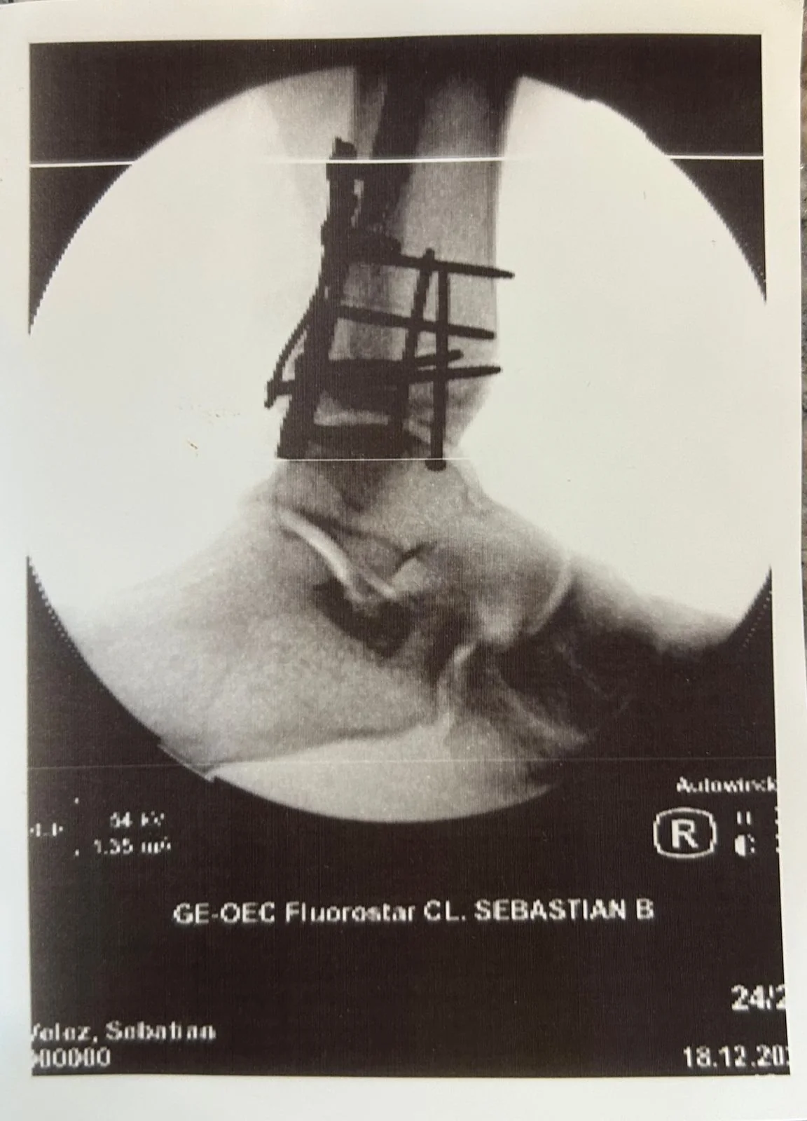 Radiografía de la lesión de tobillo que Sebastián compartió para esta historia.